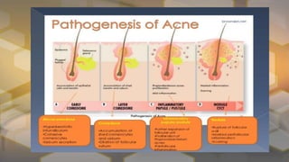 Acne vulgaris [autosaved] | PPTX