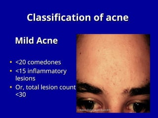 Sebaceous Pustules Acne Vulgaris is a chronic inflammatory disease of the pilosebaceous ...