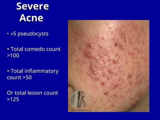 Sebaceous Pustules Acne Vulgaris is a chronic inflammatory disease of the pilosebaceous ...