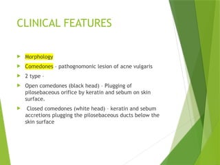 Comprehensive Overview of Acne Vulgaris: Pathogenesis, Clinical ...