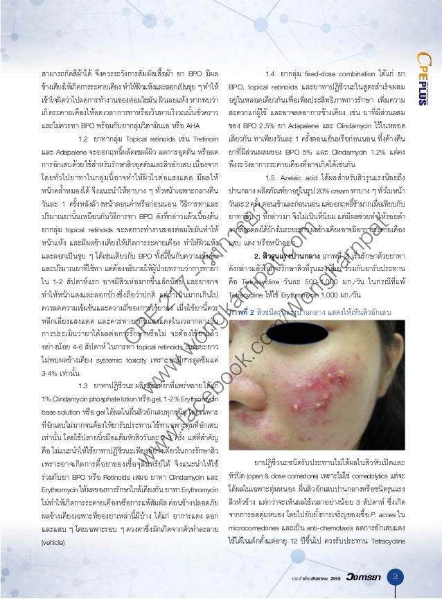 Acne vulgaris treatment & management