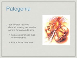 Patogenia 
Son dos los factores 
determinantes y necesarios 
para la formación de acné 
• Factores genéticos mas 
no hereditarios 
• Alteraciones hormonal 
 