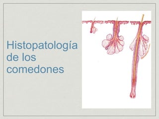 Histopatología 
de los 
comedones 
 