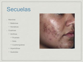 Secuelas 
Manchas 
• Melánicas 
• Hemáticas 
Cicatrices 
• Atróficas 
• Picahielo 
• Rollo 
• Cuadrangulares 
• Hipertróficas 
• Queloides 
 