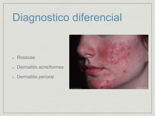 Diagnostico diferencial 
Rosácea 
Dermatitis acneíformes 
Dermatitis perioral 
 