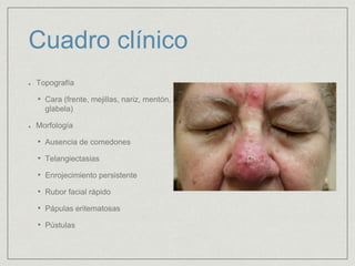 Cuadro clínico 
Topografía 
• Cara (frente, mejillas, nariz, mentón, 
glabela) 
Morfología 
• Ausencia de comedones 
• Telangiectasias 
• Enrojecimiento persistente 
• Rubor facial rápido 
• Pápulas eritematosas 
• Pústulas 
 