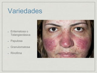 Variedades 
Eritematosa o 
Telangiectásica 
Papulosa 
Granulomatosa 
Rinofima 
 