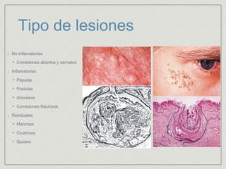 Tipo de lesiones 
No inflamatorias 
• Comedones abiertos y cerrados 
Inflamatorias 
• Pápulas 
• Pústulas 
• Abscesos 
• Comedones fistulosos 
Residuales 
• Manchas 
• Cicatrices 
• Quistes 
 