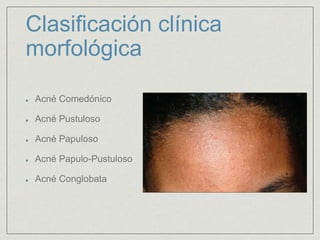 Clasificación clínica 
morfológica 
Acné Comedónico 
Acné Pustuloso 
Acné Papuloso 
Acné Papulo-Pustuloso 
Acné Conglobata 
 