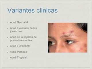 Variantes clinicas 
Acné Neonatal 
Acné Excoriado de las 
jovencitas 
Acné de la espalda de 
post-adolescentes. 
Acné Fulminante 
Acné Pomada 
Acné Tropical 
 