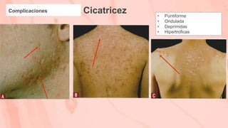 Cicatricez
Complicaciones
• Puntiforme
• Ondulada
• Deprimidas
• Hipertroficas
 