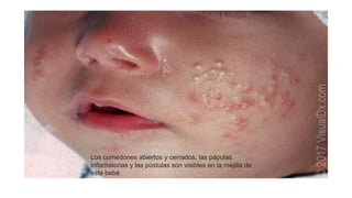 Los comedones abiertos y cerrados, las pápulas
inflamatorias y las pústulas son visibles en la mejilla de
este bebé
 