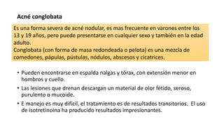 Acné conglobata
• Pueden encontrarse en espalda nalgas y tórax, con extensión menor en
hombros y cuello.
• Las lesiones que drenan descargan un material de olor fétido, seroso,
purulento o mucoide.
• E manejo es muy difícil, el tratamiento es de resultados transitorios. El uso
de isotretinoina ha producido resultados impresionantes.
Es una forma severa de acné nodular, es mas frecuente en varones entre los
13 y 19 años, pero puede presentarse en cualquier sexo y también en la edad
adulto.
Conglobata (con forma de masa redondeada o pelota) es una mezcla de
comedones, pápulas, pústulas, nódulos, abscesos y cicatrices.
 