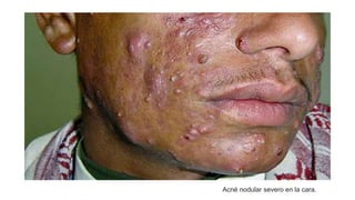 Acné nodular severo en la cara.
 