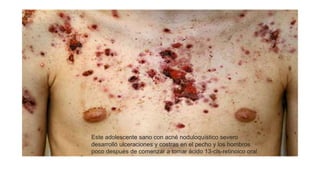 Este adolescente sano con acné noduloquístico severo
desarrolló ulceraciones y costras en el pecho y los hombros
poco después de comenzar a tomar ácido 13-cis-retinoico oral
 