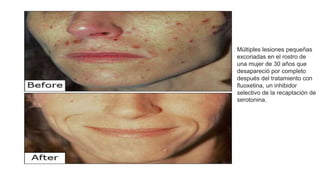 Múltiples lesiones pequeñas
excoriadas en el rostro de
una mujer de 30 años que
desapareció por completo
después del tratamiento con
fluoxetina, un inhibidor
selectivo de la recaptación de
serotonina.
 