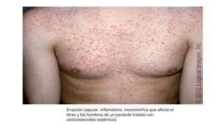 Erupción papular, inflamatoria, monomórfica que afecta el
tórax y los hombros de un paciente tratado con
corticosteroides sistémicos
 