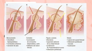 02. Exceso de cebo
Patogenia (etapas basicas)
01. Hiperproliferaxion
epidermica folicular
• Formación del Microcomedón
• Hiperqueratosis
• Cohesión de Queratinocitos
• Formación del Ostium Folicular
• Degradación de triglicéridos por el
P.acnés
• Liberación de ac. Grasos
• Estimulación androgénica de los
sebocitos
03. Inflamacion
04. Actividad del
P.acnes
• Rotura de la pared folicular
• Respuesta de linfocitos CD4 – CD8
• Presencia de neutrofilos
• P.acnés estimula el desarrollo de
anticuerpos
• Facilita la inflamacion.
• Se une a monocitos y PMN
 