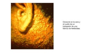 Cloracné en la cara y
el cuello de un
trabajador de una
fábrica de herbicidas.
 