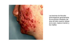 Las lesiones de foliculitis
gramnegativas generalmente
se encuentran alrededor del
área del labio superior debajo
de la nariz, hasta el mentón y
las mejillas
 