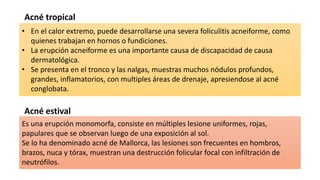 Acné tropical
Acné estival
• En el calor extremo, puede desarrollarse una severa foliculitis acneiforme, como
quienes trabajan en hornos o fundiciones.
• La erupción acneiforme es una importante causa de discapacidad de causa
dermatológica.
• Se presenta en el tronco y las nalgas, muestras muchos nódulos profundos,
grandes, inflamatorios, con multiples áreas de drenaje, apresiendose al acné
conglobata.
Es una erupción monomorfa, consiste en múltiples lesione uniformes, rojas,
papulares que se observan luego de una exposición al sol.
Se lo ha denominado acné de Mallorca, las lesiones son frecuentes en hombros,
brazos, nuca y tórax, muestran una destrucción folicular focal con infiltración de
neutrófilos.
 