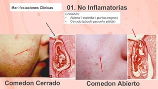 Manifestaciones Clinicas 01. No Inflamatorias
Comedón:
• Abierto ( espinilla o puntos negros)
• Cerrado (pápula pequeña pálida)
Comedon Abierto
Comedon Cerrado
 