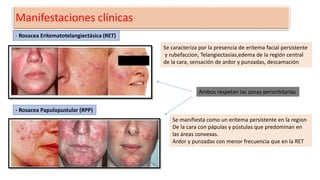 Manifestaciones clínicas
- Rosacea Eritematotelangiectásica (RET)
Se caracteriza por la presencia de eritema facial persistente
y rubefaccion, Telangiectasias,edema de la región central
de la cara, sensación de ardor y punzadas, descamación
- Rosacea Papulopustular (RPP)
Se manifiesta como un eritema persistente en la region
De la cara con pápulas y pústulas que predominan en
las áreas convexas.
Ardor y punzadas con menor frecuencia que en la RET
Ambos respetan las zonas periorbitarias
 