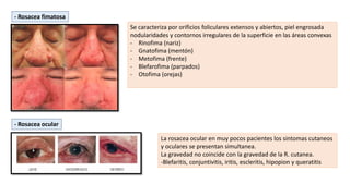 - Rosacea fimatosa
Se caracteriza por orificios foliculares extensos y abiertos, piel engrosada
nodularidades y contornos irregulares de la superficie en las áreas convexas
- Rinofima (nariz)
- Gnatofima (mentón)
- Metofima (frente)
- Blefarofima (parpados)
- Otofima (orejas)
- Rosacea ocular
La rosacea ocular en muy pocos pacientes los sintomas cutaneos
y oculares se presentan simultanea.
La gravedad no coincide con la gravedad de la R. cutanea.
-Blefaritis, conjuntivitis, iritis, escleritis, hipopion y queratitis
 