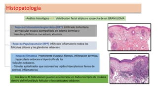 Histopatología
- Rosacea Eritematotelangiectásica (RET) Infiltrado linfocitario
perivascular escaso acompañado de edema dermico y
venulas y linfaticos con estasis, elastosis
- Rosacea Papulopustular (RPP) Infiltrado inflamatorio rodea los
foliculos pilosos y las glandulas sebaceas
- Rosacea fimatosa Prominente elastosis fibrosis, infiltracion dermica,
hyperplasia sebacea e hipertrofia de los
foliculos sebaceos.
- Túneles epitelizados que socavan los tejidos hiperplasicos llenos de
detritos inflamatorios
- Los ácaros D. folliculorum pueden encontrarse en todos los tipos de rosácea
dentro del infundíbulo folicular y los conductos sebáceos
-Análisis histológico distribución facial atípica o sospecha de un GRANULOMA
 