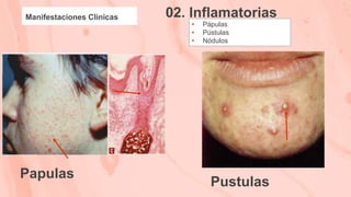 02. Inflamatorias
Manifestaciones Clinicas
• Pápulas
• Pústulas
• Nódulos
Papulas
Pustulas
 