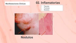 02. Inflamatorias
Manifestaciones Clinicas
• Papulas
• Pustulas
• Nodulos
Nodulos
 