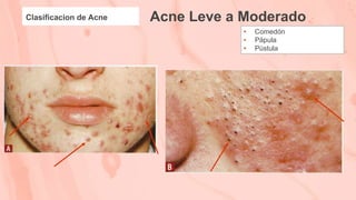 Acne Leve a Moderado
Clasificacion de Acne
• Comedón
• Pápula
• Pústula
 