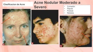 Acne Nodular Moderado a
Severo
Clasificacion de Acne
• Comedón
• Pápula
• Pústula
• Nódulos
 