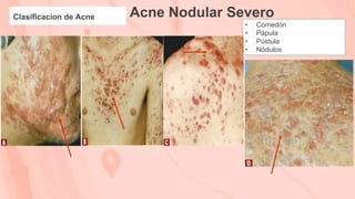 Acne Nodular Severo
Clasificacion de Acne
• Comedón
• Pápula
• Pústula
• Nódulos
 