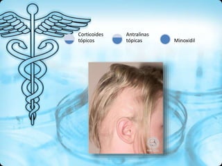 Corticoides
tópicos
Antralinas
tópicas Minoxidil
 