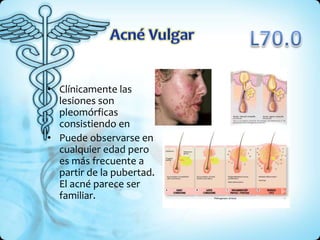 • Clínicamente las
lesiones son
pleomórficas
consistiendo en
• Puede observarse en
cualquier edad pero
es más frecuente a
partir de la pubertad.
El acné parece ser
familiar.
 