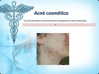 El acné cosmético muestra lesiones semejantes al acné esteroideo.
 
