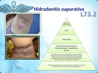 afecta a los
folículos pilosos
causa
Frecuencia
inicia con la oclusión de los
folículos pilosos - estafilococo
aureus.
Clínicamente se inicia como pápulas inflamatorias pruriginosas
que evolucionan hasta formar nódulos que pueden ser de gran
tamaño y que pueden drenar espontáneamente abundante
contenido purulento y curan dando lugar a cicatrices que con
frecuencia muestran múltiples puntos de drenaje.
El tratamiento puede incluir la administración de antibióticos, corticoides
intralesionales y sistémicos, retinoides y antiandrógenos.
 