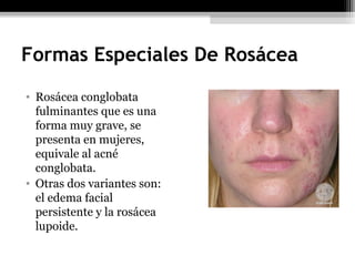 Formas Especiales De Rosácea
• Rosácea conglobata
fulminantes que es una
forma muy grave, se
presenta en mujeres,
equivale al acné
conglobata.
• Otras dos variantes son:
el edema facial
persistente y la rosácea
lupoide.
 