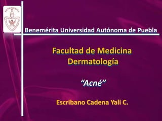 Benemérita Universidad Autónoma de Puebla


        Facultad de Medicina
            Dermatología

                 “Acné”

         Escribano Cadena Yali C.
 