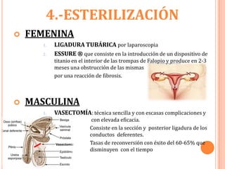 4.-ESTERILIZACIÓN
   FEMENINA
      1.   LIGADURA TUBÁRICA por laparoscopia
      2.   ESSURE ® que consiste en la introducción de un dispositivo de
           titanio en el interior de las trompas de Falopio y produce en 2-3
           meses una obstrucción de las mismas
           por una reacción de fibrosis.



   MASCULINA
      1.   VASECTOMÍA: técnica sencilla y con escasas complicaciones y
                           con elevada eficacia.
                          Consiste en la sección y posterior ligadura de los
                          conductos deferentes.
                          Tasas de reconversión con éxito del 60-65% que
                          disminuyen con el tiempo
 