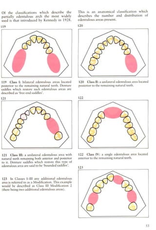 A colour atlas of removable partial dentures | PDF