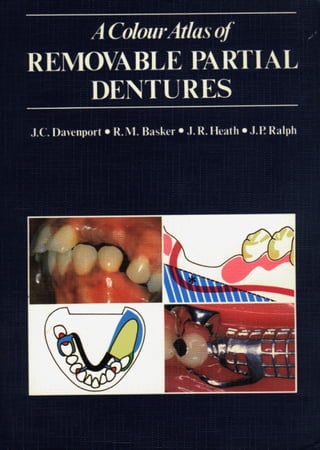 A colour atlas of removable partial dentures