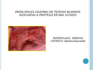PRINCIPALES LESIONES DE TEJIDOS BLANDOS
ASOCIADAS A PRÓTESIS EN MAL ESTADO
HIPERPLASIA FIBROSA
CRÓNICA (épulis fisurado)
 