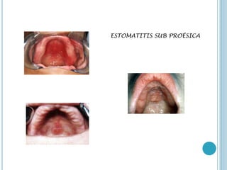 ESTOMATITIS SUB PROÉSICA
 