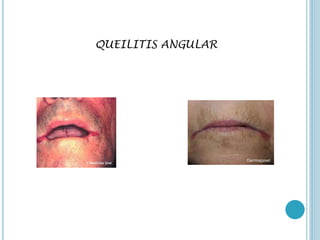 QUEILITIS ANGULAR
 
