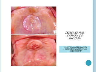 LESIONES POR
CAMARA DE
SUCCIÓN
• ELECTROCAUTERIZACION
• REMOSIÓN QUIRÚRJICA
• CRIOTERAPIA
 