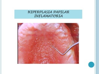 HIPERPLASIA PAPILAR
INFLAMATORIA
 