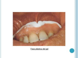 Fase plástica del gel
 