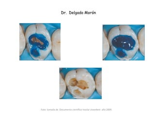 Foto tomada de Documento científico Ivoclar vivavdent año 2009.
Dr. Delgado Morón
 